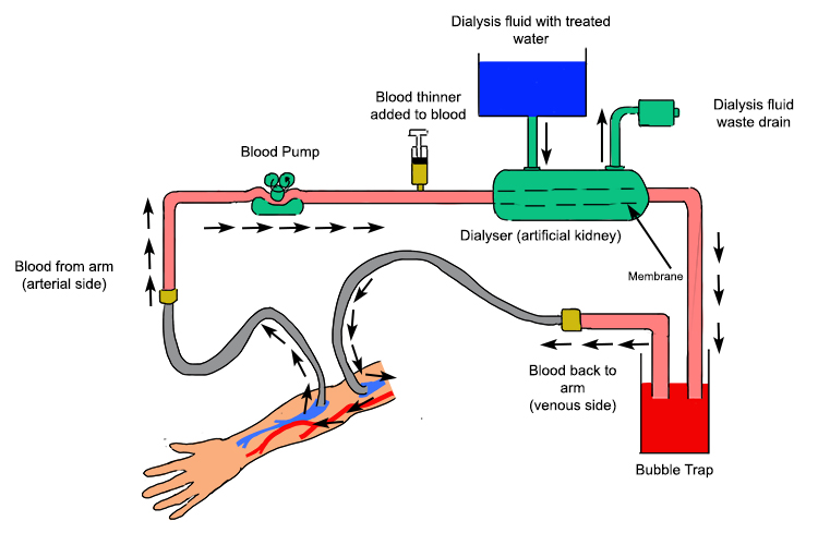 Diagram showing the blood flow of a haemodialysis system also showing the features the blood will visit to be cleaned